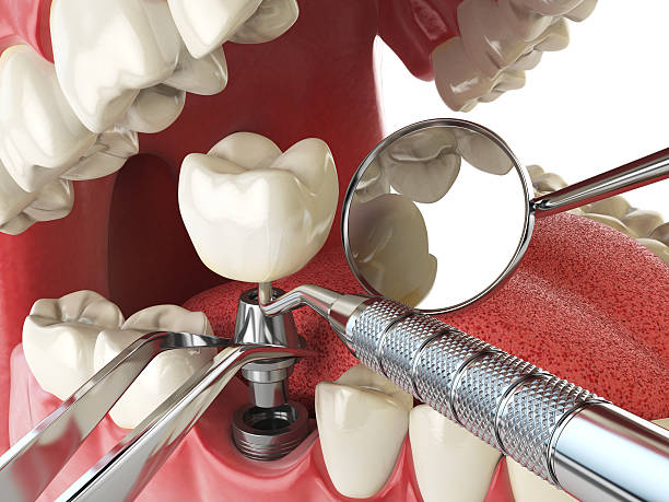 Best Emergency Tooth Extraction in Nebo, NC